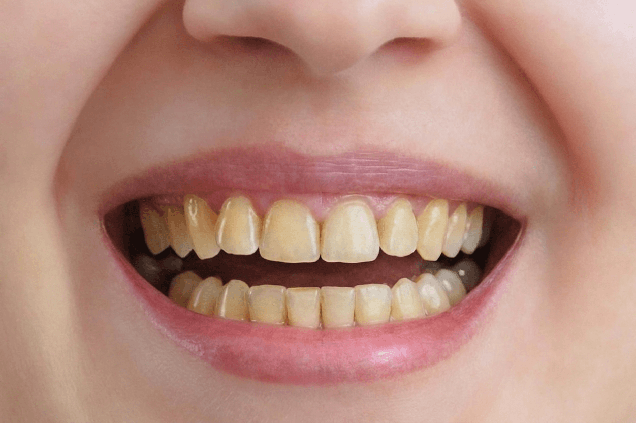 Before: close-up of the same smile with yellowed, uneven teeth